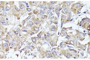 Immunohistochemistry of paraffin-embedded Human liver cancer using EIF3L Polyclonal Antibody at dilution of 1:100 (40x lens). (EIF3L anticorps)