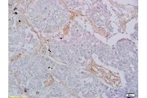 Formalin-fixed and paraffin embedded human lung carcinoma labeled with Rabbit Anti CD8 Polyclonal Antibody, Unconjugated (ABIN1385272) at 1:200 followed by conjugation to the secondary antibody and DAB staining (CD8 anticorps  (AA 51-150))