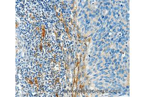 Immunohistochemistry of Human cervical cancer using DIO2 Polyclonal Antibody at dilution of 1:50 (DIO2 anticorps)
