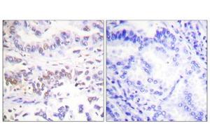 Immunohistochemistry analysis of paraffin-embedded human lung carcinoma tissue using XRCC3 antibody. (XRCC3 anticorps  (Internal Region))