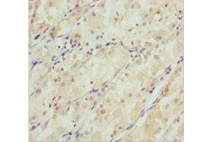 Immunohistochemistry of paraffin-embedded human gastric cancer using ABIN7171148 at dilution of 1:100 (SNAP29 anticorps  (AA 1-258))