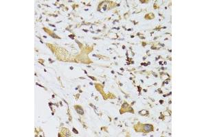Immunohistochemistry of paraffin-embedded human liver cancer using GPD2 Antibody.