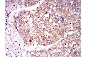 Immunohistochemical analysis of paraffin-embedded liver cancer tissues using TIE1 mouse mAb with DAB staining.