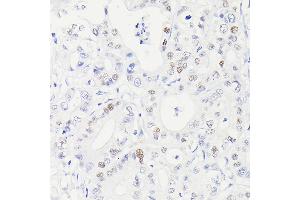Immunohistochemistry of paraffin-embedded Human hepatocholangiocarcinoma using [KO Validated] p53 Rabbit mAb (ABIN7271080) at dilution of 1:100 (40x lens).