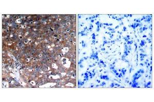Immunohistochemical analysis of paraffin-embedded human breast carcinoma tissue, using IGF-1R (Ab-1346) antibody (E021303). (IGF1R anticorps)