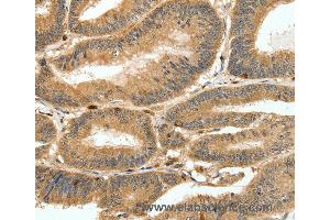 Immunohistochemistry of Human ovarian cancer using S100A4 Polyclonal Antibody at dilution of 1:80 (s100a4 anticorps)