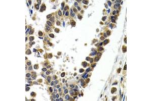 Immunohistochemistry of paraffin-embedded human mammary cancer using ATF2 antibody.
