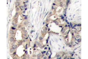 Immunohistochemistry of paraffin-embedded Human breast carcinoma using Phospho-ABL1(Y412) Polyclonal Antibody (ABL1 anticorps  (pTyr412))