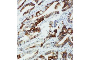 Anti-CYP2U1 antibody, IHC(P) IHC(P): Human Intestinal Cancer Tissue (CYP2U1 anticorps  (C-Term))