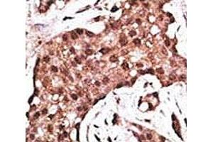 IHC analysis of FFPE human breast carcinoma tissue stained with the ATG5 antibody (ATG5 anticorps  (AA 1-30))