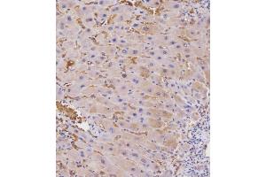 Immunohistochemical analysis of E on paraffin-embedded Human hepato carcinoma tissue. (beta 2 Adrenergic Receptor anticorps  (AA 345-373))