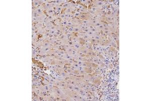 Immunohistochemical analysis of E on paraffin-embedded Human hepato carcinoma tissue.