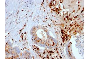 Formalin-fixed, paraffin-embedded human Liver Carcinoma and Macrophages stained with Cathepsin D Mouse Monoclonal Antibody (CTSD/3082). (Cathepsin D anticorps  (AA 104-250))