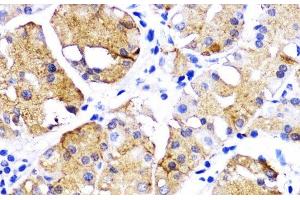 Immunohistochemistry of paraffin-embedded Human gastric cancer using BMPR1B Polyclonal Antibody at dilution of 1:200 (40x lens).