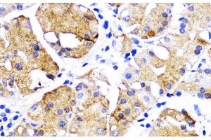 Immunohistochemistry of paraffin-embedded Human gastric cancer using BMPR1B Polyclonal Antibody at dilution of 1:200 (40x lens). (BMPR1B anticorps)