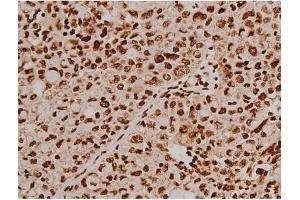 ABIN6267607 at 1/200 staining Human lung cancer tissue sections by IHC-P.