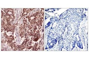 Immunohistochemical analysis of paraffin-embedded human breast carcinoma tissue, using NFκB-p105/p50 (Phospho-Ser927) antibody (E011312). (NFKB1 anticorps  (pSer927))