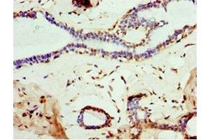 Immunohistochemistry of paraffin-embedded human breast cancer using ABIN7160457 at dilution of 1:100 (MOG anticorps  (AA 30-154))
