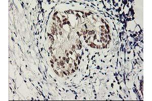 Immunohistochemical staining of paraffin-embedded Adenocarcinoma of Human breast tissue using anti-SERPINB13 mouse monoclonal antibody.