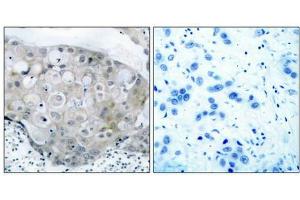 Immunohistochemical analysis of paraffin-embedded human breast carcinoma tissue using VEGFR2(Phospho-Tyr951) Antibody(left) or the same antibody preincubated with blocking peptide(right). (VEGFR2/CD309 anticorps  (pTyr951))