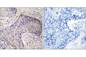 Immunohistochemistry analysis of paraffin-embedded human prostate carcinoma tissue, using ST6GAL1 Antibody. (ST6GAL1 anticorps  (AA 171-220))