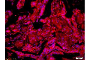 Formalin-fixed and paraffin-embedded human rectal carcinoma labeled with Anti-GTSE-1 Polyclonal Antibody, Unconjugated (ABIN741405) 1:200, overnight at 4°C, The secondary antibody was Goat Anti-Rabbit IgG, Cy3 conjugated used at 1:200 dilution for 40 minutes at 37°C.