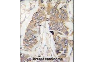 Formalin-fixed and paraffin-embedded human breast carcinoma tissue reacted with CASC3 Antibody (C-term) (ABIN391401 and ABIN2841404) , which was peroxidase-conjugated to the secondary antibody, followed by DAB staining.
