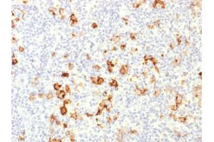 Formalin-fixed, paraffin-embedded human Hodgkin's Lymphoma stained with CD15 Rabbit Polyclonal Antibody. (CD15 anticorps)