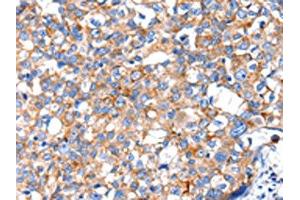 The image on the left is immunohistochemistry of paraffin-embedded Human breast cancer tissue using ABIN7130018(KLK15 Antibody) at dilution 1/15, on the right is treated with fusion protein.