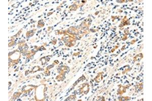 The image on the left is immunohistochemistry of paraffin-embedded Human gastric cancer tissue using ABIN7192279(SCN2A Antibody) at dilution 1/25, on the right is treated with synthetic peptide. (SCN2A anticorps)
