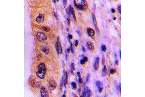Immunohistochemical analysis of PHLDA3 staining in human lung cancer formalin fixed paraffin embedded tissue section. (PHLDA3 anticorps)