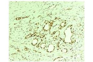 human prostate tumor Primary Antibodies (from Aviva, Thoc1, Cat No: ARP 40578-P050)(1:150 dilution) (THOC1 anticorps  (C-Term))