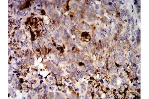 Immunohistochemical analysis of paraffin-embedded stomach cancer tissues using MUC5AC mouse mAb with DAB staining. (MUC5AC anticorps  (AA 5528-5627))
