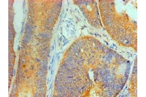 Immunohistochemical of paraffin-embedded Human Colon cancer tissue using ABIN7156047 at dilution of 1:200.