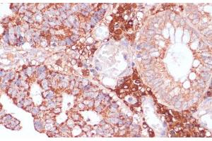 Immunohistochemistry of paraffin-embedded Human colon carcinoma using MZB1 Polyclonal Antibody at dilution of 1:100 (40x lens). (MZB1 anticorps)