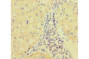 Immunohistochemistry of paraffin-embedded human liver cancer using ABIN7172513 at dilution of 1:100