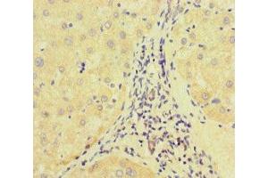 Immunohistochemistry of paraffin-embedded human liver cancer using ABIN7172513 at dilution of 1:100 (E2F1 anticorps  (AA 133-362))