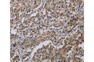 Immunohistochemistry of Human brain  using MGLL Polyclonal Antibody at dilution of 1:40 (MGLL anticorps)
