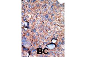 Formalin-fixed and paraffin-embedded human breast cancer tissue reacted with IKBKE polyclonal antibody  , which was peroxidase-conjugated to the secondary antibody, followed by AEC staining. (IKKi/IKKe anticorps  (C-Term))