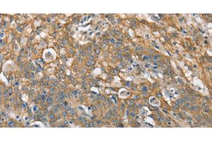 Immunohistochemistry of paraffin-embedded Human gastric cancer tissue using CSMD1 Polyclonal Antibody at dilution 1:40 (CSMD1 anticorps)