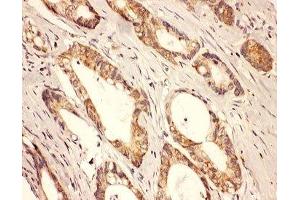 IHC-P: Rab8 antibody testing of human intestine cancer tissue (RAB8A anticorps  (C-Term))