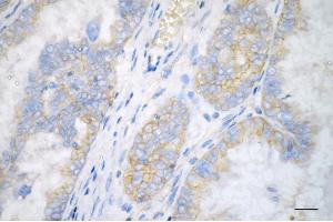 Immunohistochemistry was performed on paraffin-embedded human ovarian carcinoma using adducin 1 antibody (ABIN7797513), 1:200). (alpha Adducin anticorps)