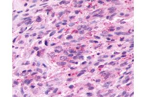 Anti-PROKR2/Prokineticin Receptor 2 antibody IHC of human Brain, Glioblastoma. (Prokineticin Receptor 2 anticorps  (C-Term))