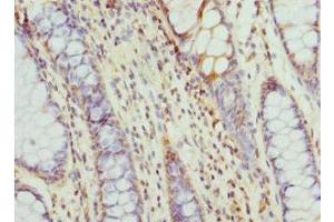Immunohistochemistry of paraffin-embedded human colon cancer using ABIN7171417 at dilution of 1:100 (CCT5 anticorps  (AA 1-270))