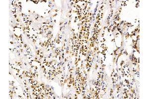 ABIN7094692 and ABIN7098743 at 1/100 staining Human pancreatic cancer by IHC-P. (LMX1A anticorps  (Internal Region))