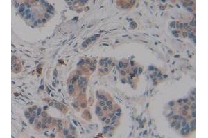 Detection of CPB2 in Human Breast cancer Tissue using Polyclonal Antibody to Carboxypeptidase B2 (CPB2)