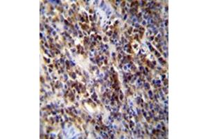 Immunohistochemistry analysis in formalin fixed and paraffin embedded human lymphoma reacted with PAPR9 Antibody (C-term) followed which was peroxidase conjugated to the secondary antibody followed byand DAB staining. (PARP9 anticorps  (C-Term))