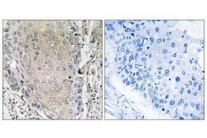 Immunohistochemistry analysis of paraffin-embedded human lung carcinoma tissue using CBLN3 antibody. (CBLN3 anticorps  (C-Term))