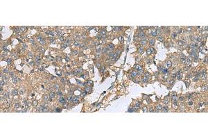 Immunohistochemistry of paraffin-embedded Human liver cancer tissue using EIF1AX Polyclonal Antibody at dilution of 1:65(x200) (EIF1AX anticorps)