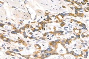 Immunohistochemistry analysis of paraffin-embedded human stomach cancer using MRPL12 (ABIN7074638) at dilution of 1: 1000 (MRPL12 anticorps)